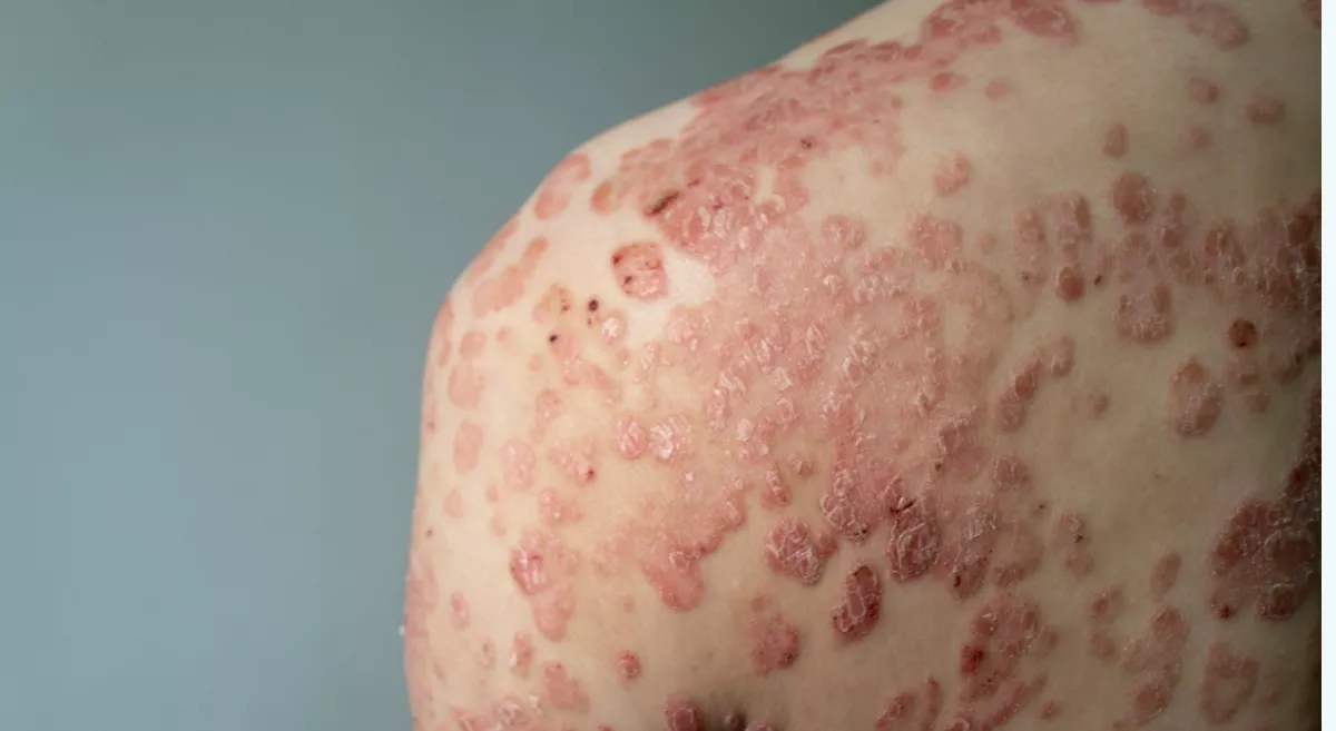 Understanding Psoriasis: Chronic Skin Condition | Aster CMI Hospital